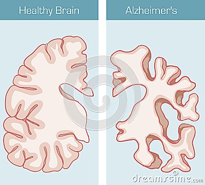 Alzheimer`s Disease Vector Illustration