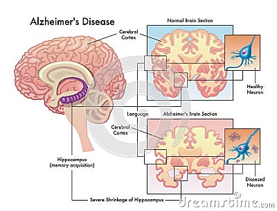 Alzheimer`s disease Vector Illustration