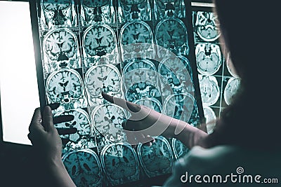 Alzheimer`s disease on MRI Stock Photo