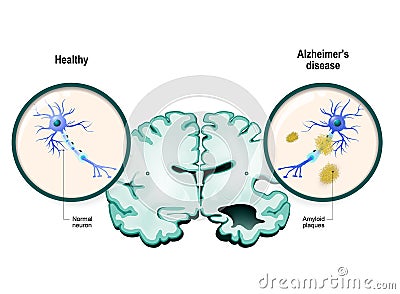 Alzheimer`s disease. Neurons and brain Vector Illustration