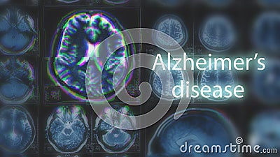 Alzheimer`s disease or Parkinson concept. Blurred MRI scan of brain with glitch effect Stock Photo