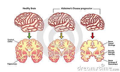 Alzheimer's disease progression Vector Illustration