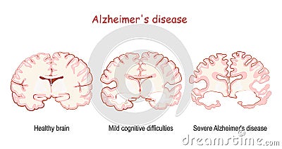 Alzheimer`s, is a neurodegenerative disease. dementia Vector Illustration
