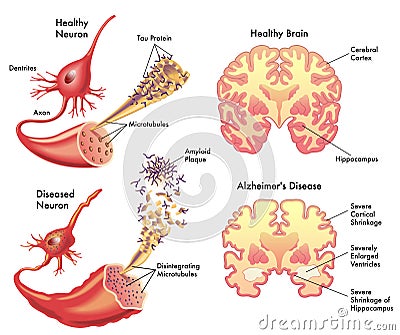 Alzheimers disease Vector Illustration