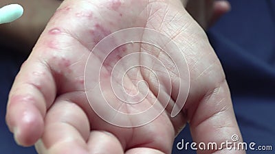 metal tiburón Legibilidad Amamantar Ampollas Limpiadoras Herpes Zóster En La Mano Del Paciente Almacen De Video - Vídeo de dorsal, viral: 205264885 metal tiburón Legibilidad Amamantar Ampollas Limpiadoras Herpes Zóster En La Mano Del Paciente Almacen De Video - Vídeo de dorsal, viral: 205264885