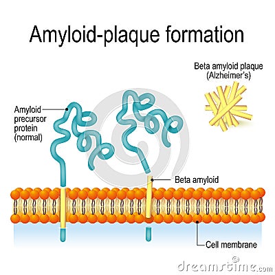 Amyloid-plaque formation. Alzheimer`s disease Vector Illustration