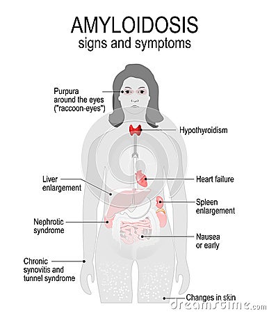 Amyloidosis. Signs and symptoms. Vector Illustration