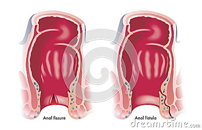 Anal fissure and fistula Vector Illustration