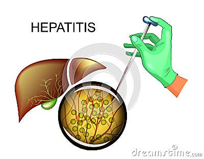 Analysis for hepatitis C and liver disease Vector Illustration