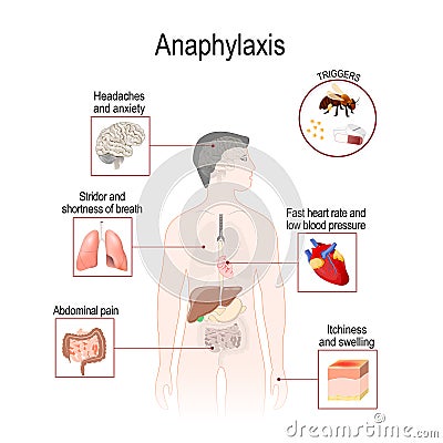 Anaphylaxis is a serious allergic reaction that may cause death Vector Illustration