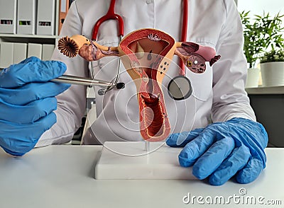 Anatomical model of uterus with pathologies closeup Stock Photo