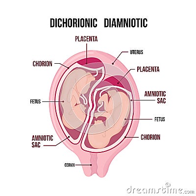 Anatomy of abdomen with twins. pregnancy type infographic elements in flat design. Vector Illustration