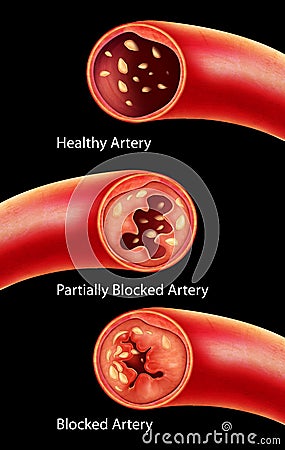 Anatomy of Atherosclerosis in artery Stock Photo
