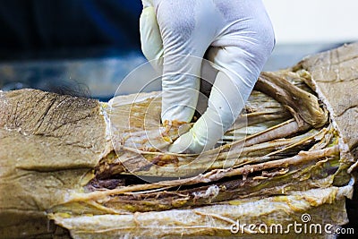 Anatomy dissection of a cadaver showing adductor canal using scalpel scissors and forceps cutting skin flap revealing important st Stock Photo