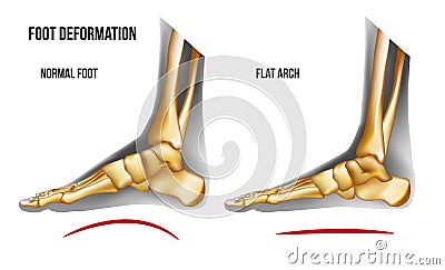 Anatomy flat foot arch medial view Vector Illustration