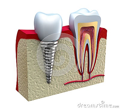 Anatomy of healthy teeth and dental implant Stock Photo