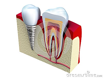 Anatomy of healthy teeth and dental implant in jaw Stock Photo