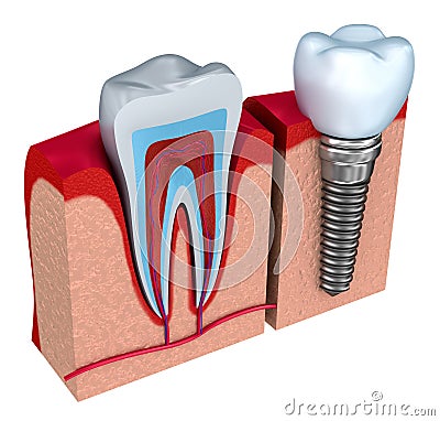 Anatomy of healthy teeth and dental implant in jaw bone. Stock Photo