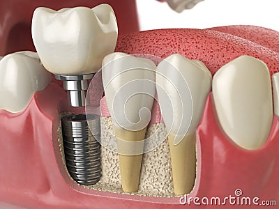 Anatomy of healthy teeth and tooth dental implant in human denturra. Cartoon Illustration