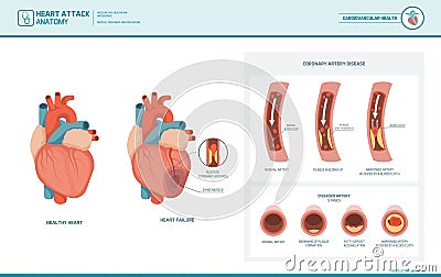 Anatomy of a heart attack Vector Illustration