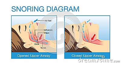 Anatomy of human airway while snoring Vector Illustration