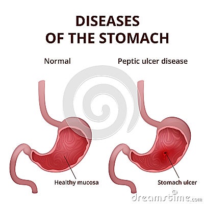 Anatomy of the human healthy and unhealthy stomach Vector Illustration