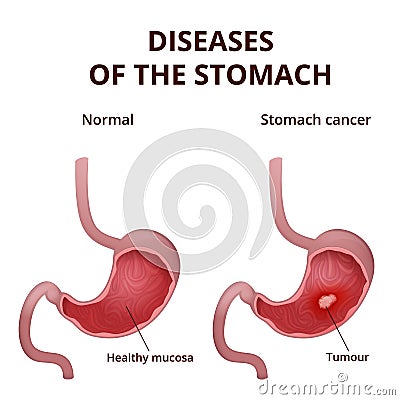 Anatomy of the human stomach Vector Illustration