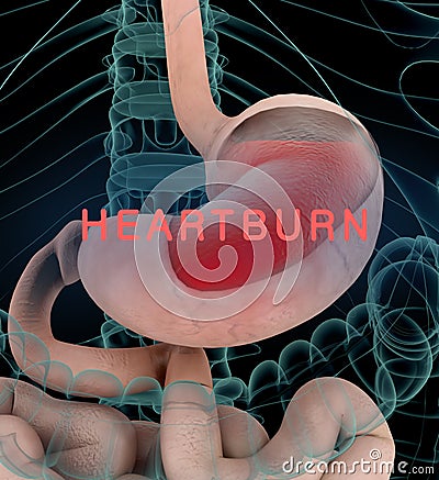 Anatomy illustration of gastric acid or heartburn, inflamed red stomach showing acid in red. Cartoon Illustration