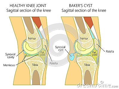 Anatomy of the knee_Baker`s cyst Vector Illustration