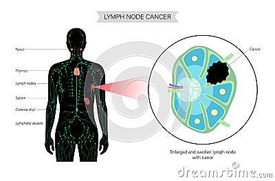 Lymphoma cancer concept Vector Illustration