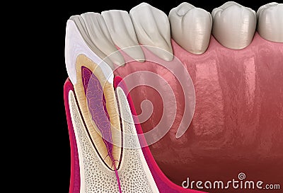 Anatomy of maxillary lateral incisor tooth and gum cross section. Medically accurate dental 3D illustration Cartoon Illustration