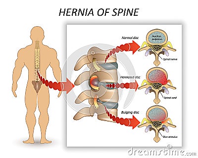 Anatomy medical diagram of a human spine with the hernia and description of all sections and segments of the vertebrae, vector. Vector Illustration