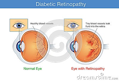 Anatomy of normal eye and Diabetic retinopathy. Vector Illustration