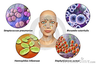 Anatomy of rhinosinusitis and bacteria that cause sinusitis Cartoon Illustration