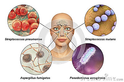 Anatomy of rhinosinusitis and microorganisms that cause sinusitis Cartoon Illustration