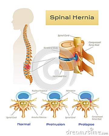 Anatomy Spinal Hernia Infographics Vector Illustration