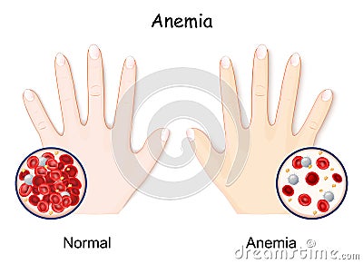 Anemia. hand of healthy human and anaemia Vector Illustration