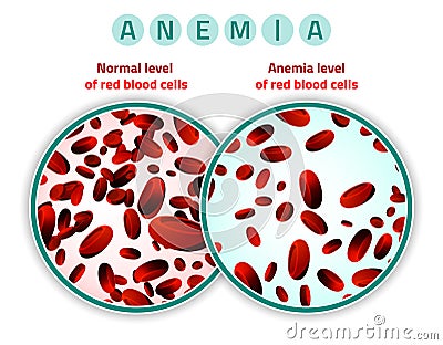 Anemia level of blood cells Vector Illustration