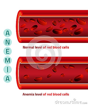 Anemia level of blood cells Vector Illustration