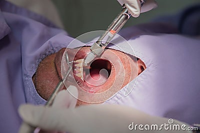 Anesthesia for tooth extraction by the dentist. Dentistry in hospital Stock Photo