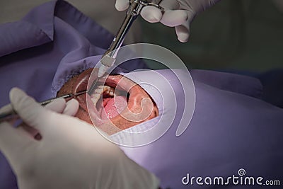 Anesthesia for tooth extraction by the dentist. Dentistry in hospital Stock Photo