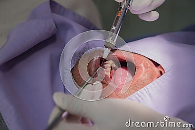 Anesthesia for tooth extraction by the dentist. Dentistry in hospital Stock Photo