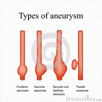 Aneurysm. Types aneurysm. Infographics. Vector illustration Vector Illustration