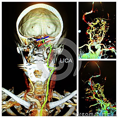 Angio neuro ct neck exam acute left cerebral infarction Stock Photo