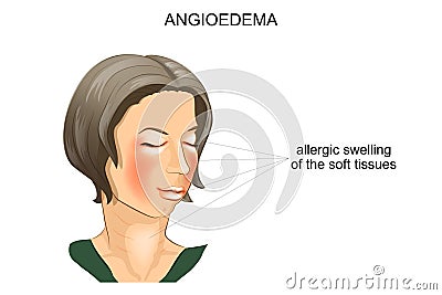Angioedema. allergic swelling Vector Illustration