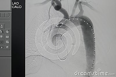 Angiogram of right common iliac artery after aortic stent graft deployed at infra renal abdominal aortic aneurysm during Stock Photo