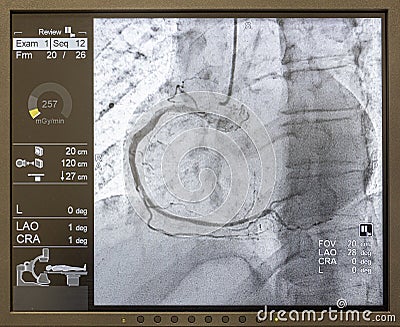 Angiogram sequence working clockwise using x-rays with a contrast agent injected from a tube inserted into the arteries (left & Stock Photo