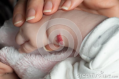 Angioma or pink hemangioma on a baby`s arm Stock Photo