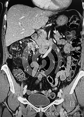 Angiomyolipoma right kidney pathology ct exam Stock Photo