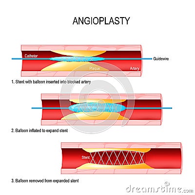 Angioplasty. Stent Implantation. Vector Illustration